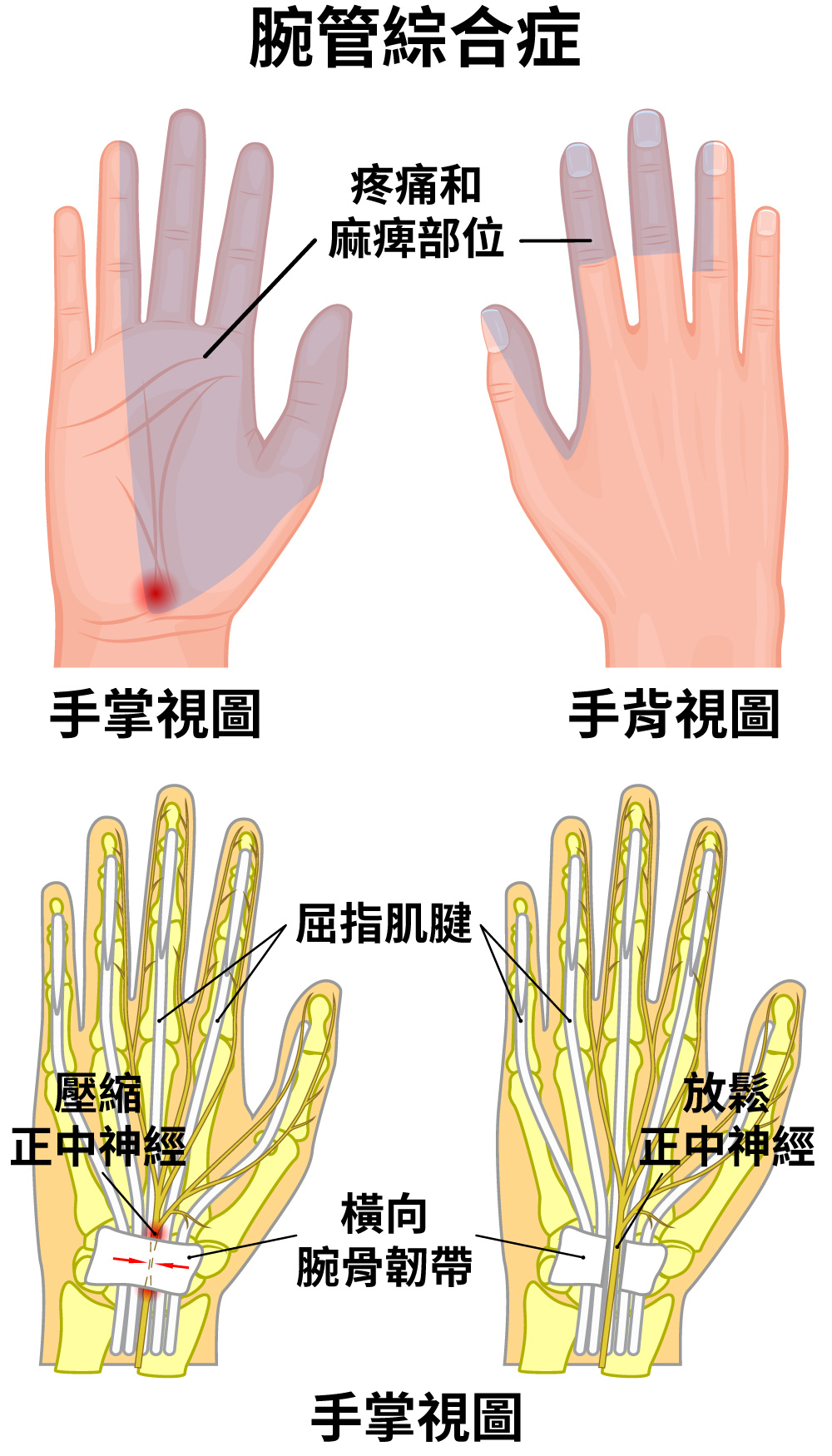 明確的腕管綜合徵，麻痺和癱瘓