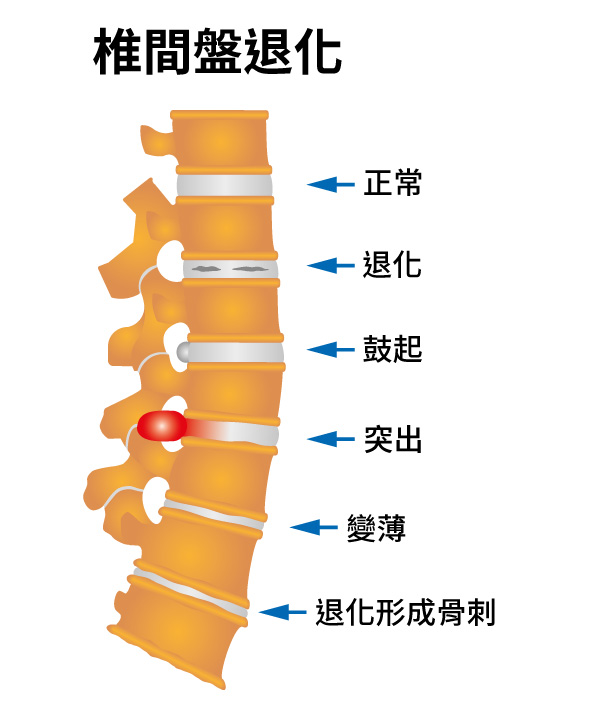 頸肩椎間盤退變包括正常椎間盤，退行性椎間盤，膨出椎間盤，椎間盤突出，變薄椎間盤和具有骨贅形成的椎間盤退變。